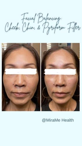 Facial Balancing: P - 1
