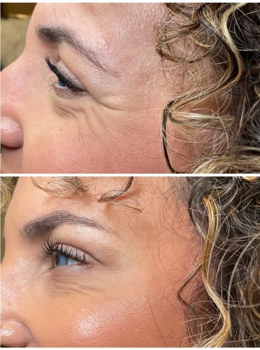 Botox Before & After