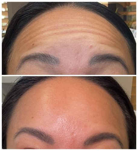 Botox Before & After