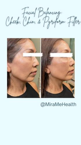 Facial Balancing: P - 2