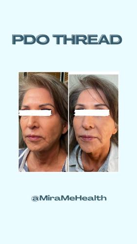 Facial balancing : Cheeks, Chin, Nasolabial folds - 1