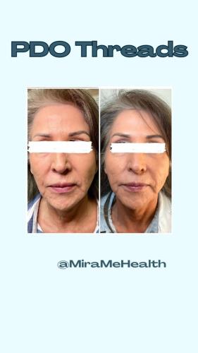 Facial balancing : Cheeks, Chin, Nasolabial folds - 2