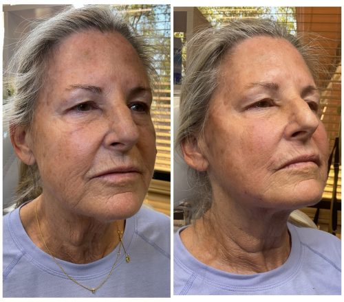 PDO Threads Before & After